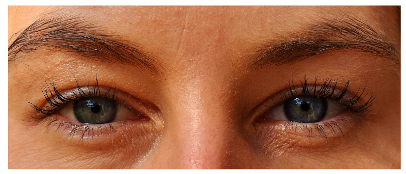 The Clear View: Is it Dry Eye Disease or Allergies? 